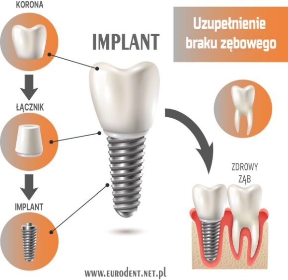 Jak zbudowany jest implant