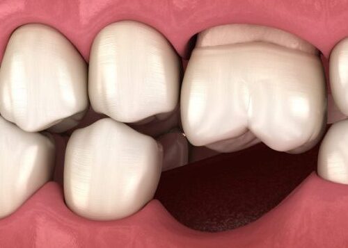 Utrata pojedynczego zęba, a efekt Godona