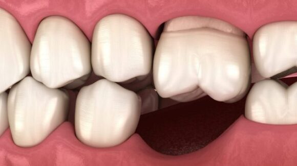 Utrata pojedynczego zęba, a efekt Godona