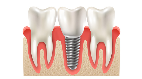 Implanty Zębowe Rzeszów: Co Musisz Wiedzieć?