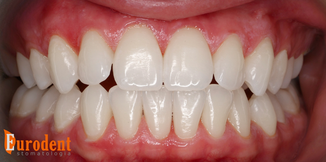 ortodoncja metamorfoza pacjęta po