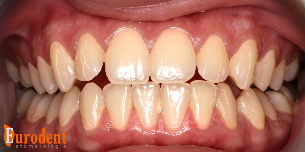 ortodoncja metamorfoza pacjęta przed